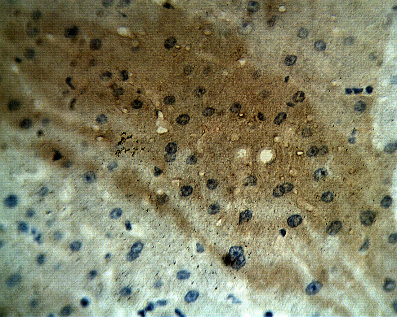 Staining on paraffin embedded human hepatocellular carcinoma sections. Primary Ab at 10 µg/ml. Antigen retrieval used: 10 mM Na Citrate pH 6.0, 10 minutes pressure cooker method, developed with anti rabbit HRP and DAP substrate.  Counterstained with methyl blue.